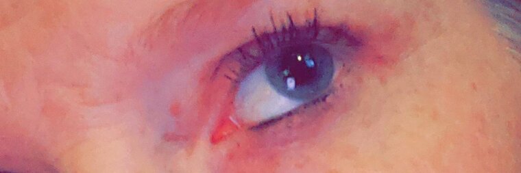 Freckleface banner image