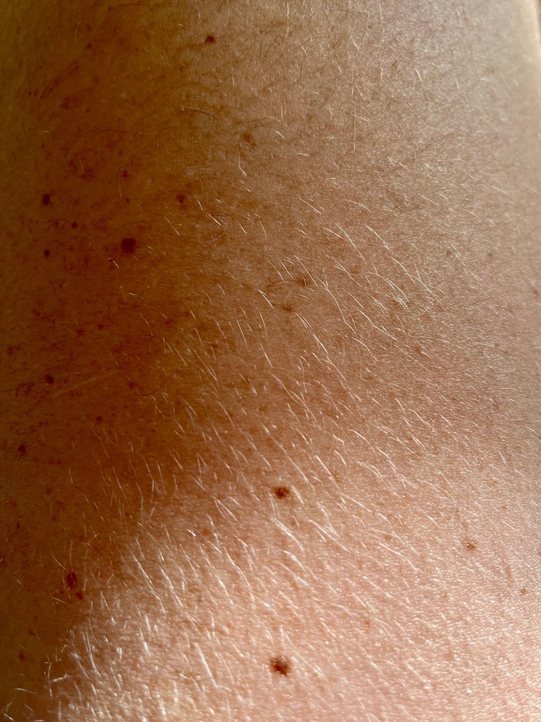 Freckles banner image