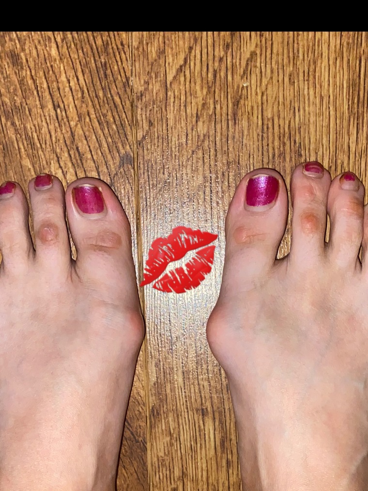 OnlyFeetBunions banner image